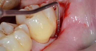 Rigenerazione tissutale guidata  su difetti intraossei profondi  con anatomia complessa