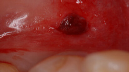Accelerated generation of human induced pluripotent stem cells from human oral mucosa using episomal plasmid vectors and maternal transcription factor Glis1