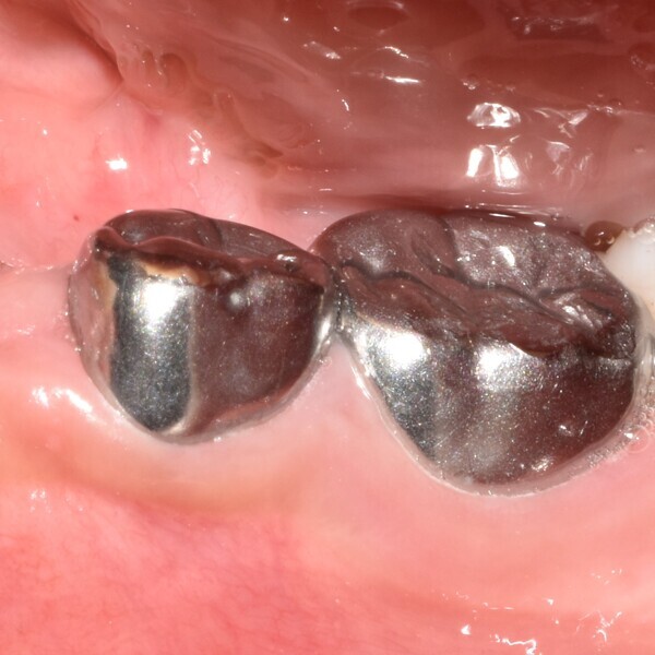 Fig. 9 : Aspect clinique lors de l’évaluation finale montrant un tissu gingival sain.