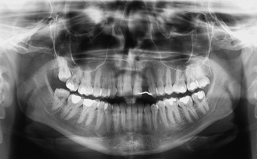 Fig. 1 : Radiographie panoramique. Il faut noter l’espace restreint en position de la dent 22. 