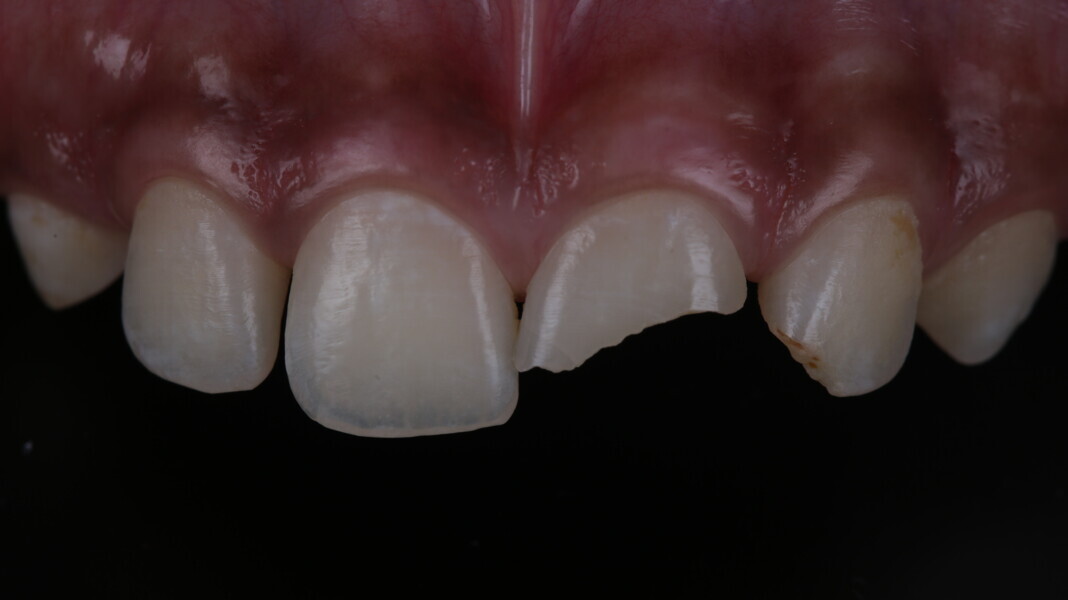 Fig 1: Intraoral view of the initial situation (class IV fracture with 11 and 12).