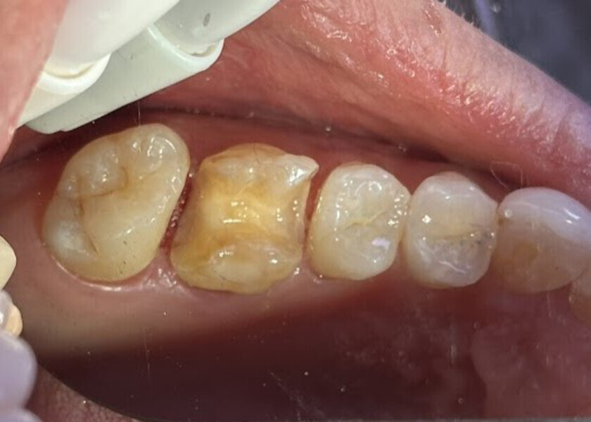 Fig. 16: Tooth surface after acid etching and application of bonding agent.