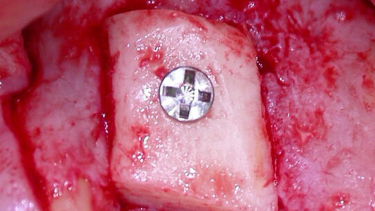 Innesti ossei e implantologia a protesizzazione immediata in zone ad alta valenza estetica