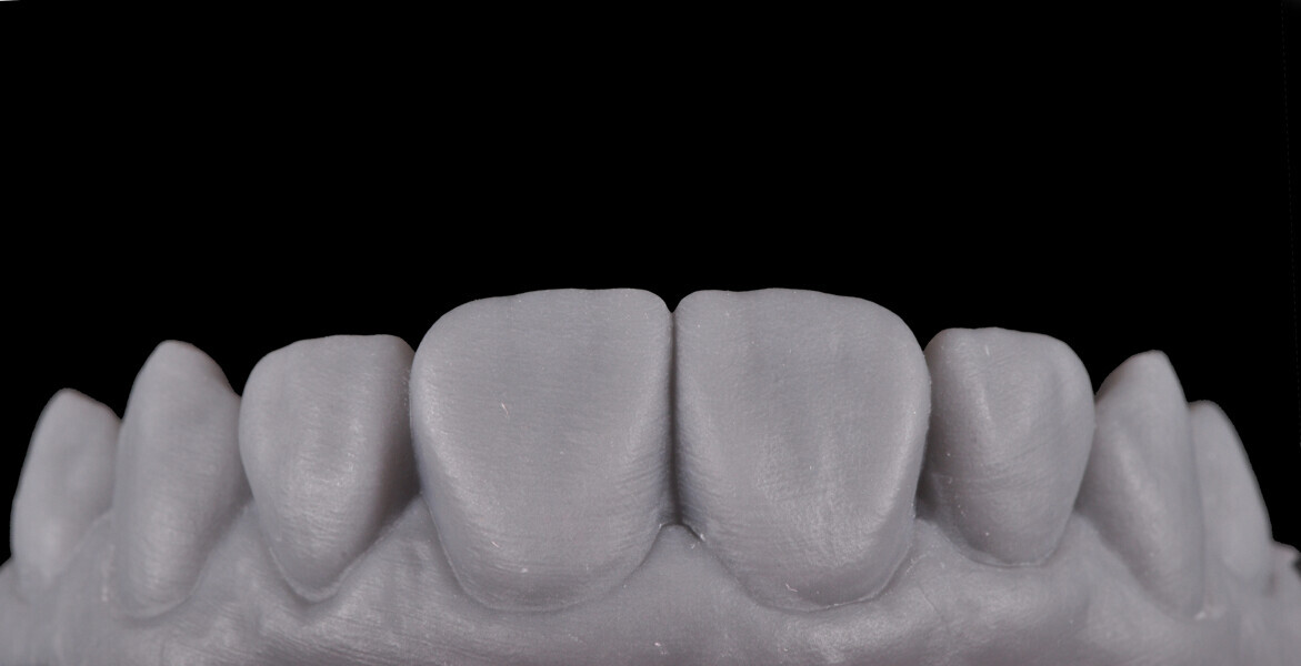 Fig. 4: Printed model based on a digital diagnostic wax-up from a digital impression.