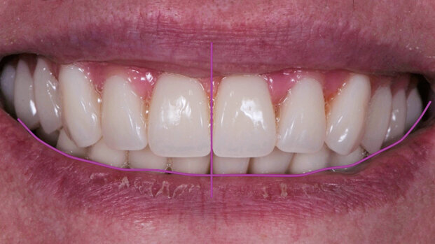 Restauri implantoprotesici: la sfida di creare un sorriso esteticamente gradevole  in un paziente edentulo