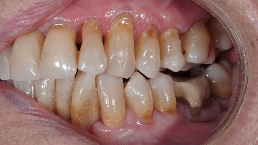 Fig. 3: Open bite in the mandibular left posterior region.