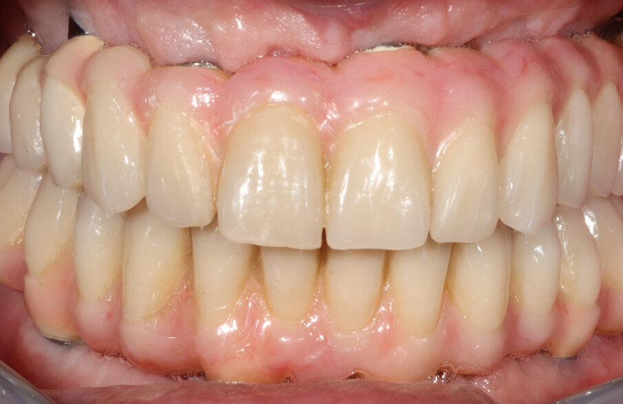 Fig. 9_La protesi definitiva.