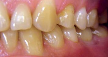 Interdyscyplinarne podejście do leczenia implantoprotetycznego