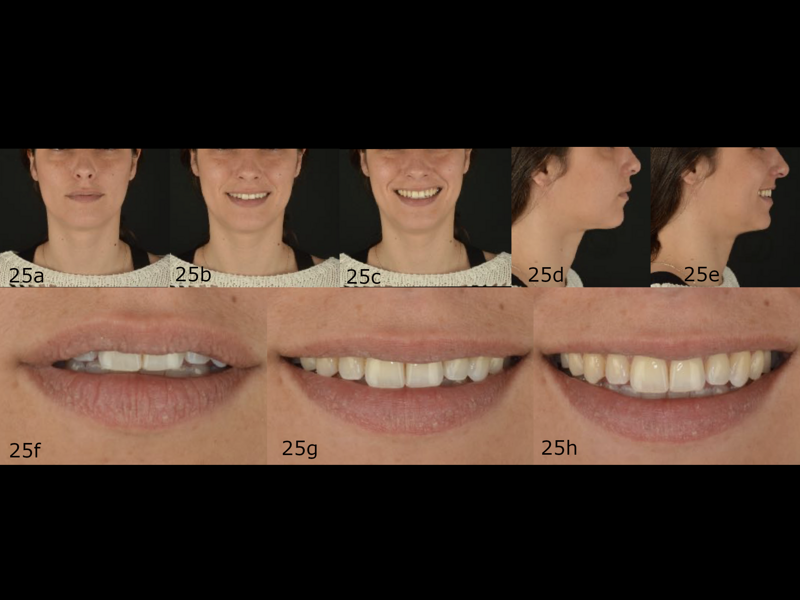 Figs. 25a–h: Post-treatment extra-oral photographs.