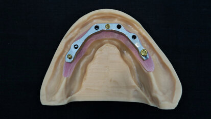 3D fabrication workflow: Solid and lattice-structured titanium alloy dental implant overdenture bars