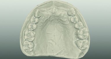 Materials and systems for all ceramic CAD/CAM restorations