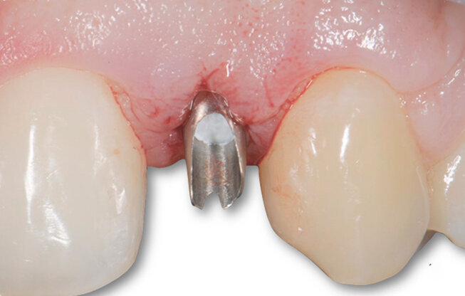 Fig. 5 - Moncone in posizione.