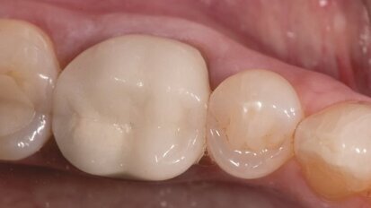 Ceramika – uzasadnienie wyboru materiału