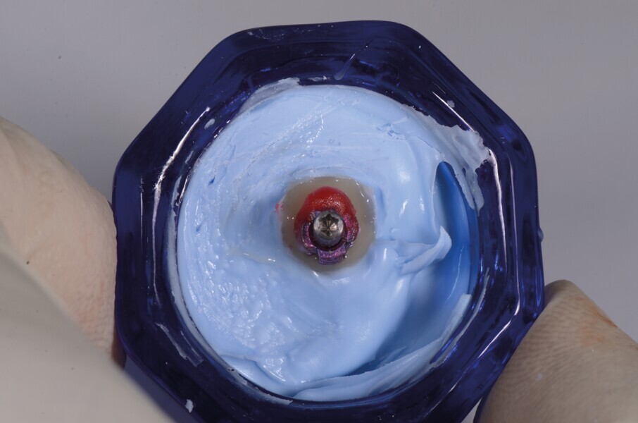 | Fig. 17 : Le transfert d’empreinte est vissé par-dessus et le profil d’émergence puis reproduit en résine acrylique.