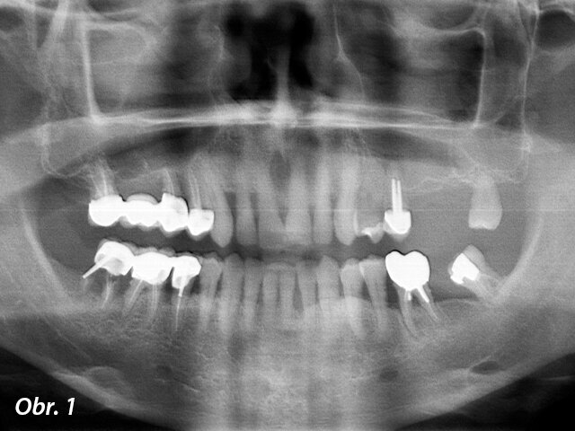 Předoperační RTG: dva premoláry a třetí molár v levé části maxily musely být extrahovány a pod čelistní dutinou nebylo dostatek kosti umožňující zavedení implantátů.