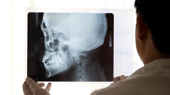 Bei Rheuma immer auch zum MKG-Chirurgen