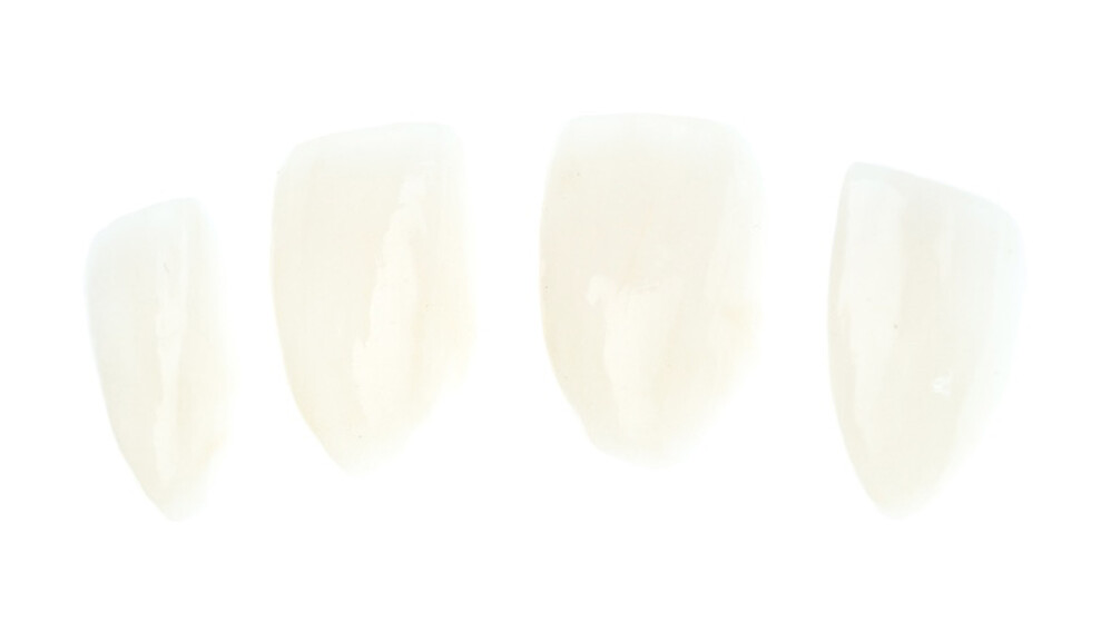 Fig. 7: Selection of IPS e.max translucency to support shade matching and masking of the underlying tooth structure.