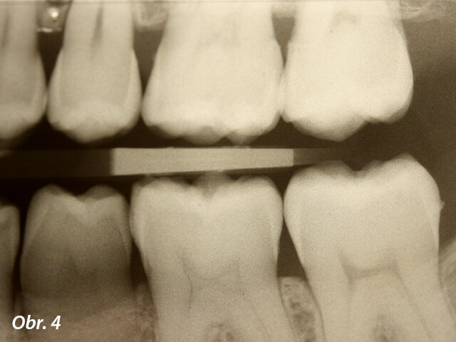 RTG snímek typu bitewing levého úseku.