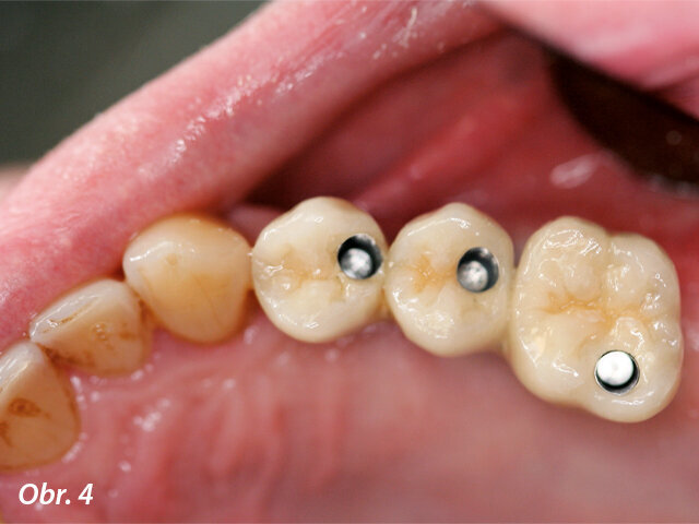 Metalokeramická náhrada byla našroubována na fixtury (keramika na titanu).