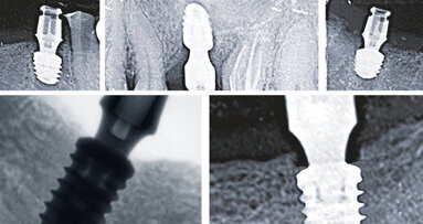 Improved osseointegration thanks to bredent’s Bone Growth Concept