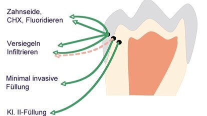 Kariestherapie im Seitenzahnbereich