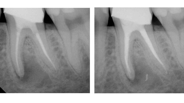 Removal of warm carrier-based products with the Twisted File