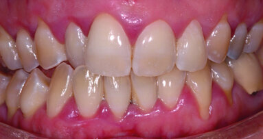 Intérêt des restaurations adhésives céramiques en dentisterie non invasive