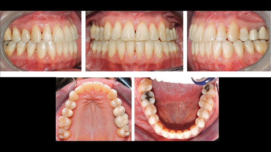 Fig. 11_Immagini intraorali che mostrano la simmetria delle arcate.