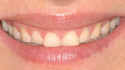 Invasivité minimale – Efficacité maximale