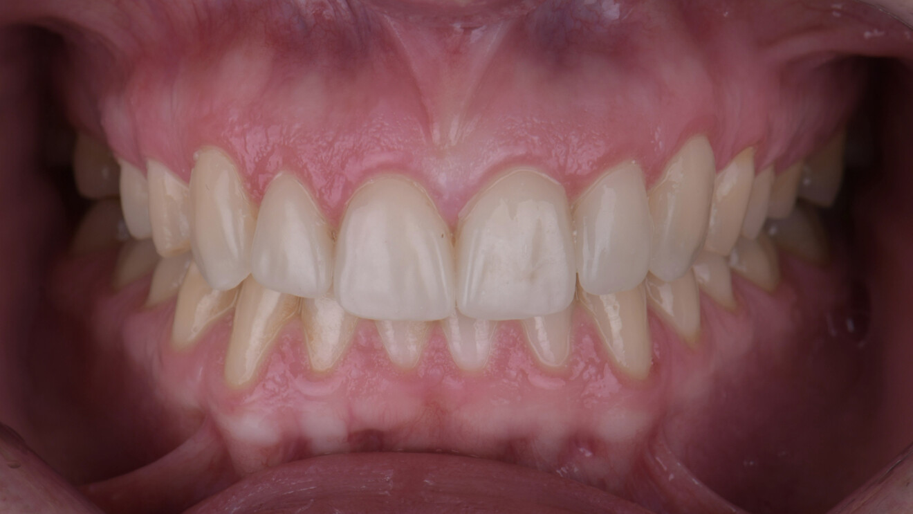 Fig. 8b: Intra-oral frontal view with the teeth in intercuspation.