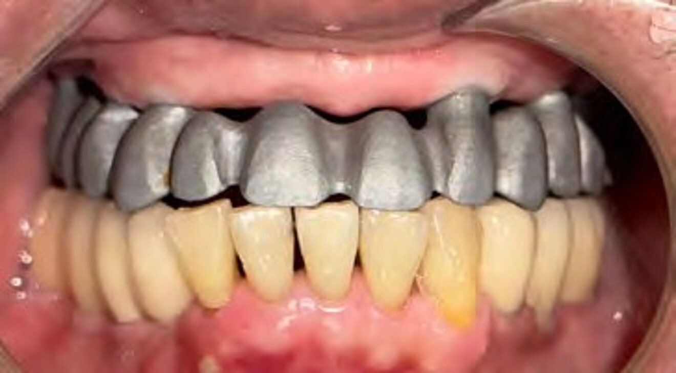 Fig. 2e: Pre-prosthetic frontal intraoral view demonstrating the edentulous maxilla and partially restored mandibular arch before  definitive prosthetic rehabilitation.
