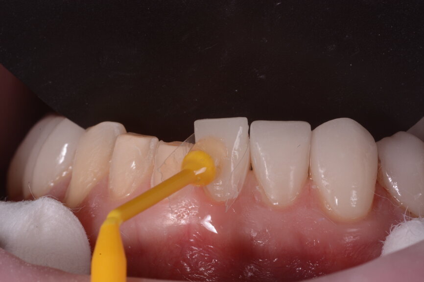 Fig. 12: The crowns (#11–13 and 21–23) and veneers (#14–17, 24–27, 31–37 and 41–47) were secured to the abutments using a light-cured resin adhesive (Futurabond U and Bifix QM).