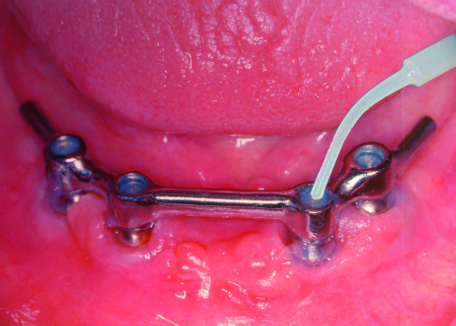 Fig. 4: Filling of an implant bar construction in the mandible with GapSeal.