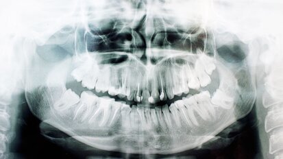 Leeftijd schatten op basis van verstandskiezen niet wetenschappelijk onderbouwd