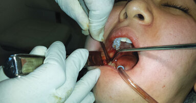 Extraction Academy can help clinicians take skills to next level