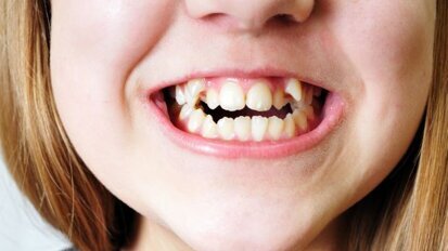 Landbouw zorgde voor scheve tanden