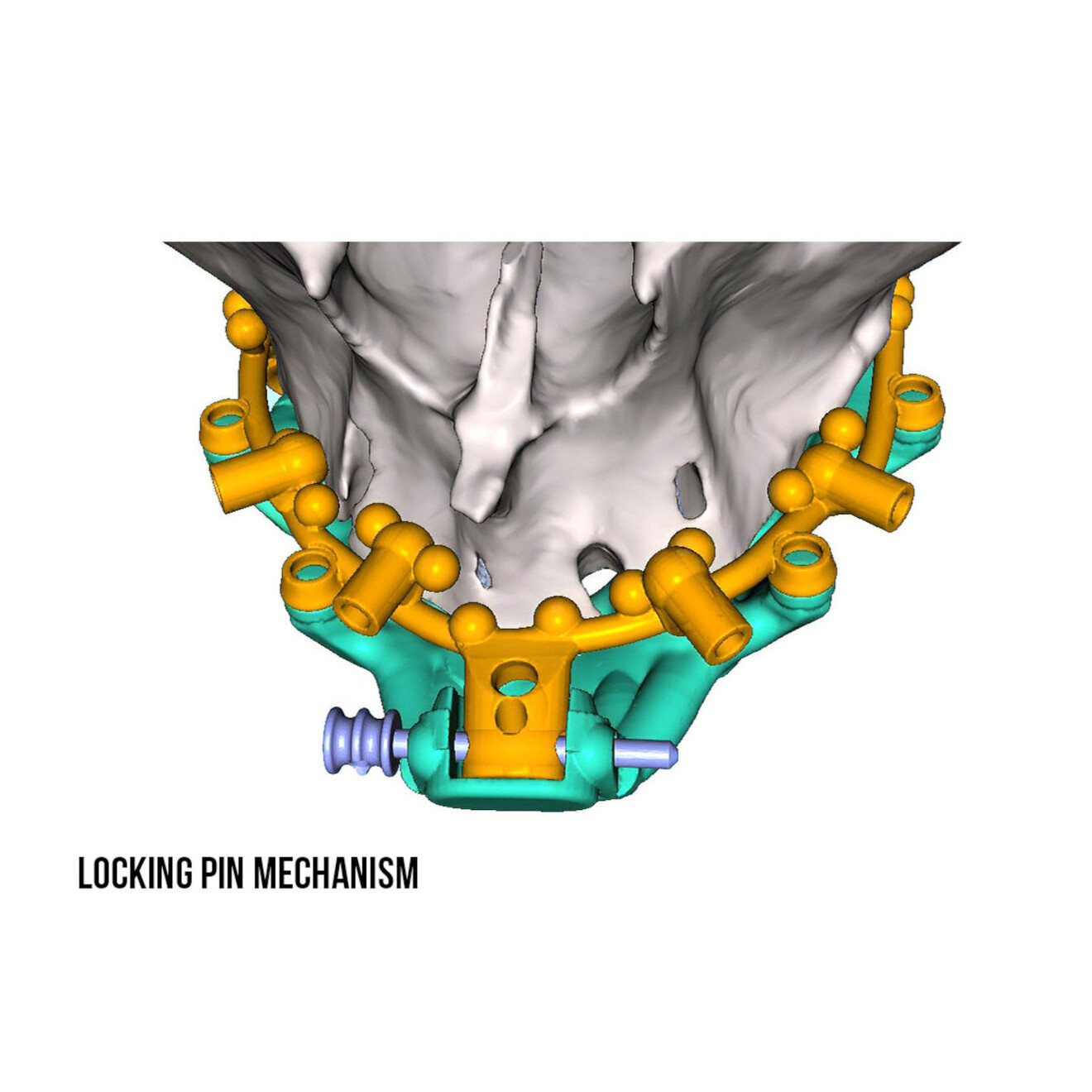 Fig. 14b: Anterior positive seat for the osteotomy drill guide  secured with a horizontal locking pin.