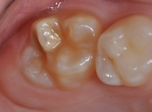 The photograph shows a mild form of MIH. Discoloration indicating the soft enamel can be seen on the occlusal surface of the molar. An important characteristic of such enamel is a hardness reduced by a factor of ten, resulting in likely caries and infraction of the surface under masticatory load. (Photograph: Prof. Norbert Krämer)