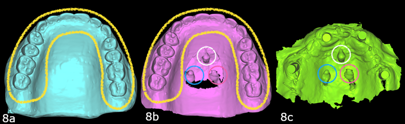 Figs. 8a–c: Scan of the maxillary trial prosthesis (a). Scan of the trial prosthesis with three TADs in the centre of the palate (b). Intra-oral scan of the four maxillary implants with the three TADs (c).