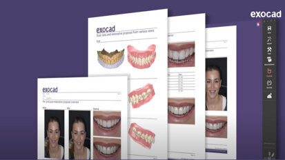 exocad –  DentalCAD 3.2 Elefsina Feature Release