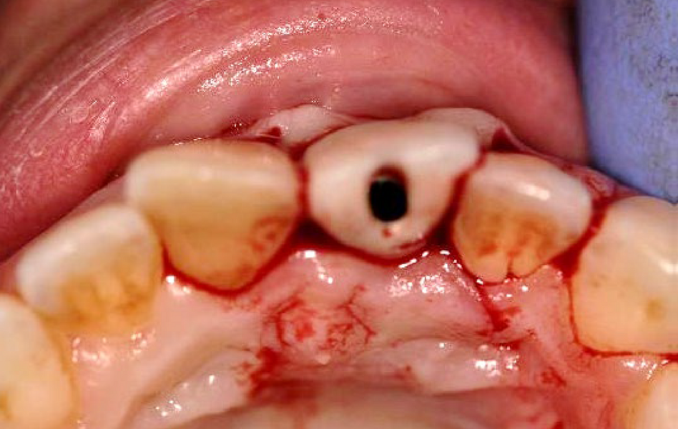  Immediate temporary crown (c) ... 