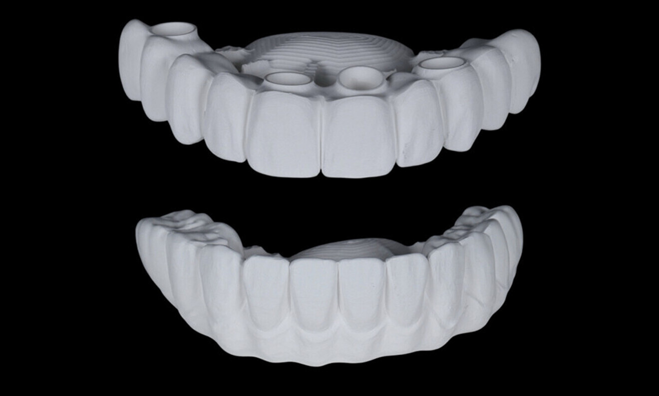 Figs. 69–75: The definitive restorations were fabricated after a five-month healing period