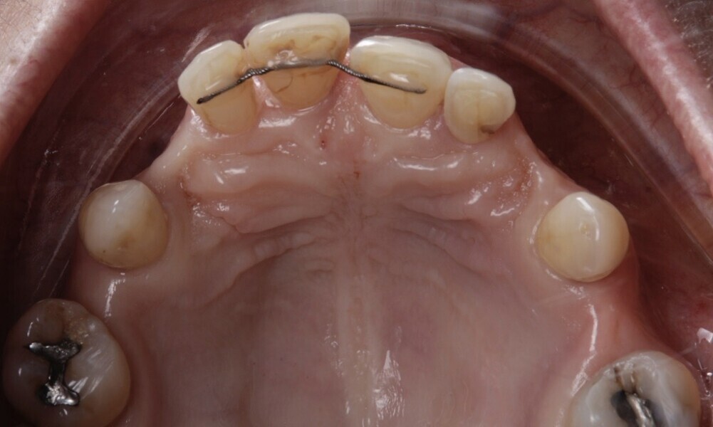 Figs. 51–55: All maxillary teeth, except the molars, were extracted after checking the seating and adaptation of the provisional restoration. 