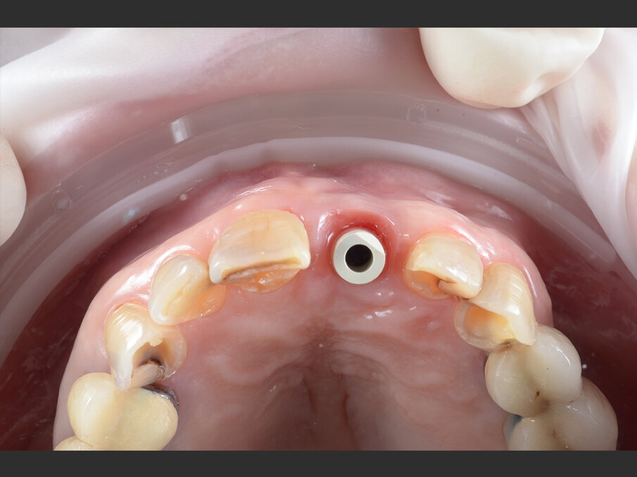 Figg. 9a, 9b - Acquisizione intraorale: tragitto transmucoso in visione occlusale.