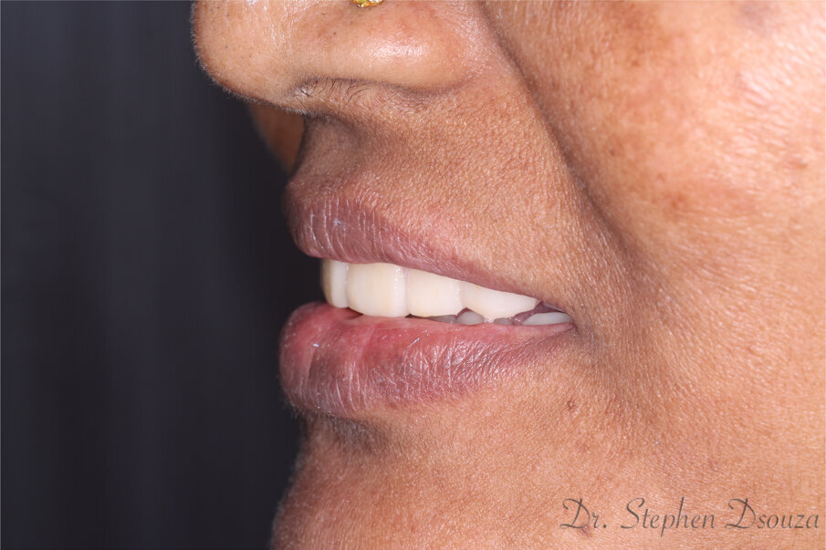 Fig. 17: Smile, oblique 