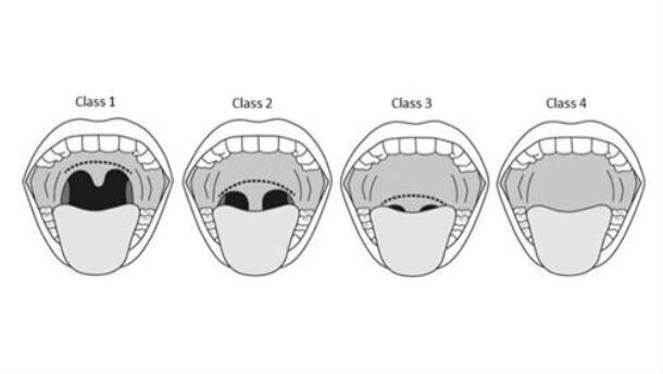 Trattamento dei disturbi del sonno con Laser Er:YAG Fotona