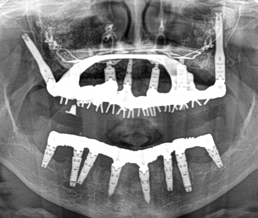 Fig. 1 bridge coulé vissé métal - résine