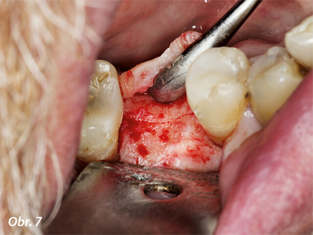 Odklopený mukoperiostální lalok, laterální pohled.