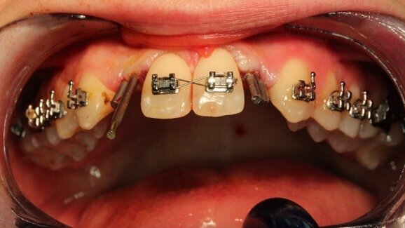 Wszczepy igłowe w hipodoncji siekaczy bocznych szczęki ze skrajnie cienkim wyrostkiem zębodołowym