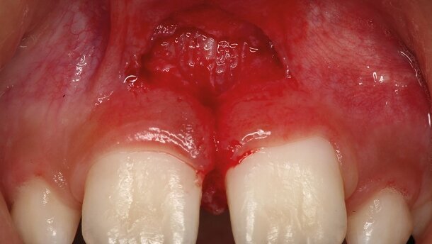 Les lasers Erbium en odontologie pédiatrique